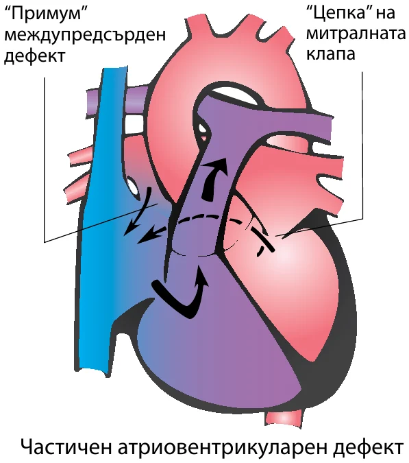 Схема на сърцето при Частичен атриовентрикуларен септален дефект