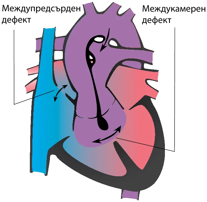 Схема на сърцето при Транспозиционни синдроми (комплексна транспозиция)