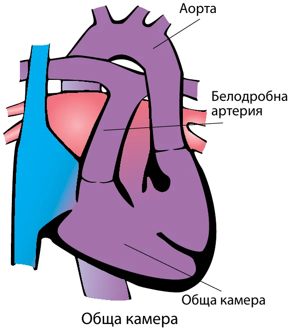 Схема на сърцето при Дефекти тип „Обща камера“