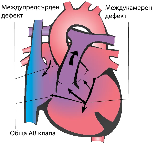 Схема на сърцето при Пълен атриовентрикуларен септален дефект