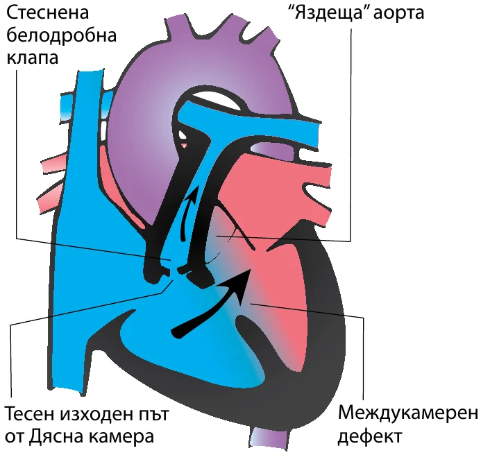 Схема на сърцето при Тетралогия на Фало