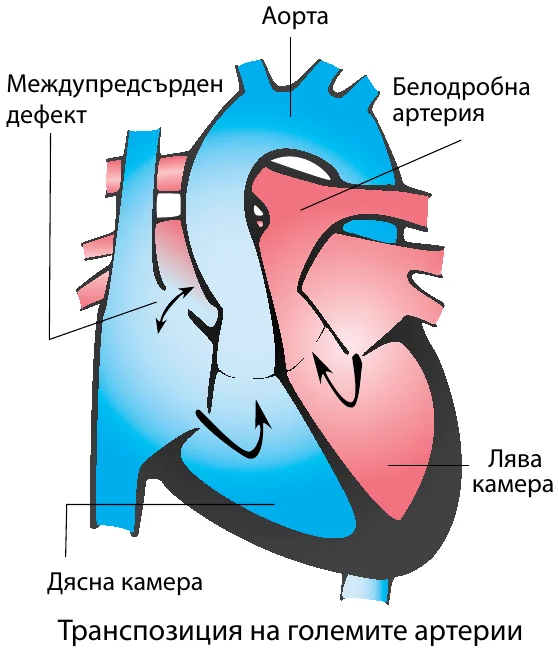Схема на сърцето при Изолирана транспозиция на големите артерии